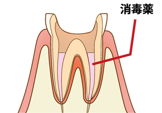 根管形成・根管洗浄