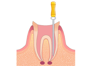 根管治療とは